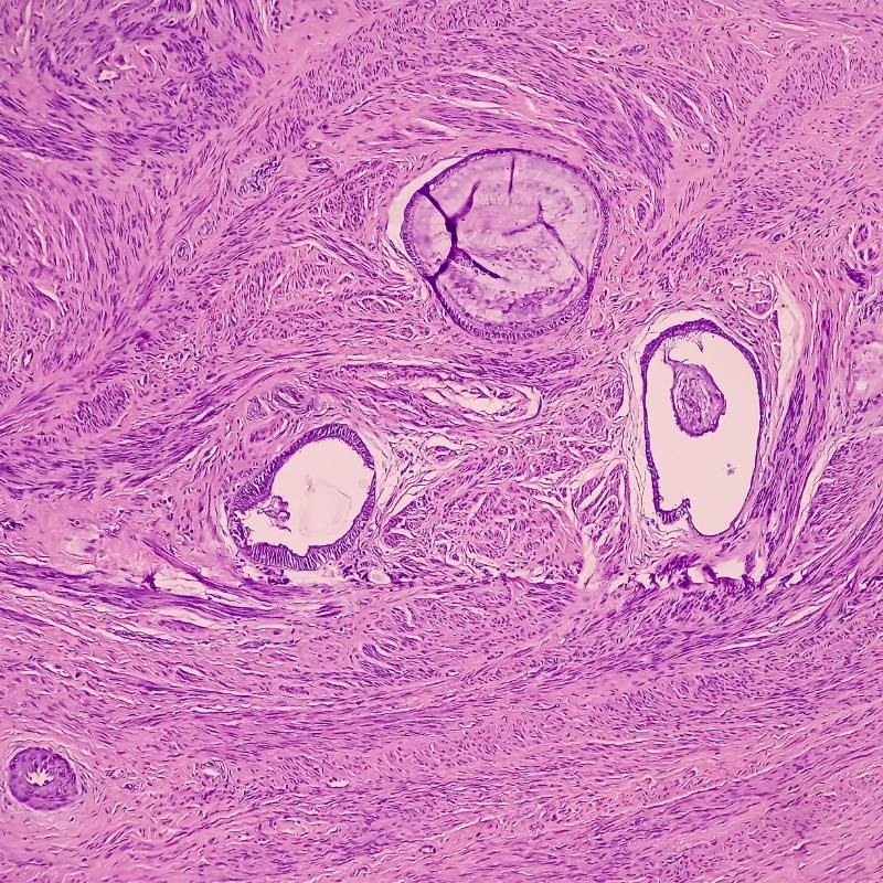 Uterus biyopsisi: Kronik servisit, leiomyoma, endometriotik kist, subepitelyal tabakada kronik inflamatuar hücreler görülür. Miyom.