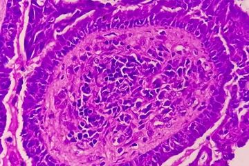 Endometrial Polip Nedir?