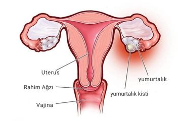 Yumurtalık Kisti Çeşitleri
